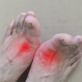 The Power of Homeo Treatment for Gout: Understanding Triggers and Benefits