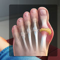 The Power of Homeo Treatment for Gout: Addressing the Root Cause