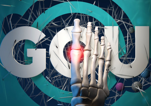 Homeo Treatment for Gout: Addressing Lifestyle Factors