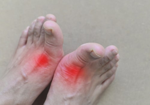 Managing Gout Triggers: A Holistic Approach