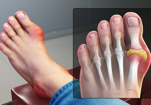 The Power of Homeo Treatment for Gout: Addressing the Root Cause